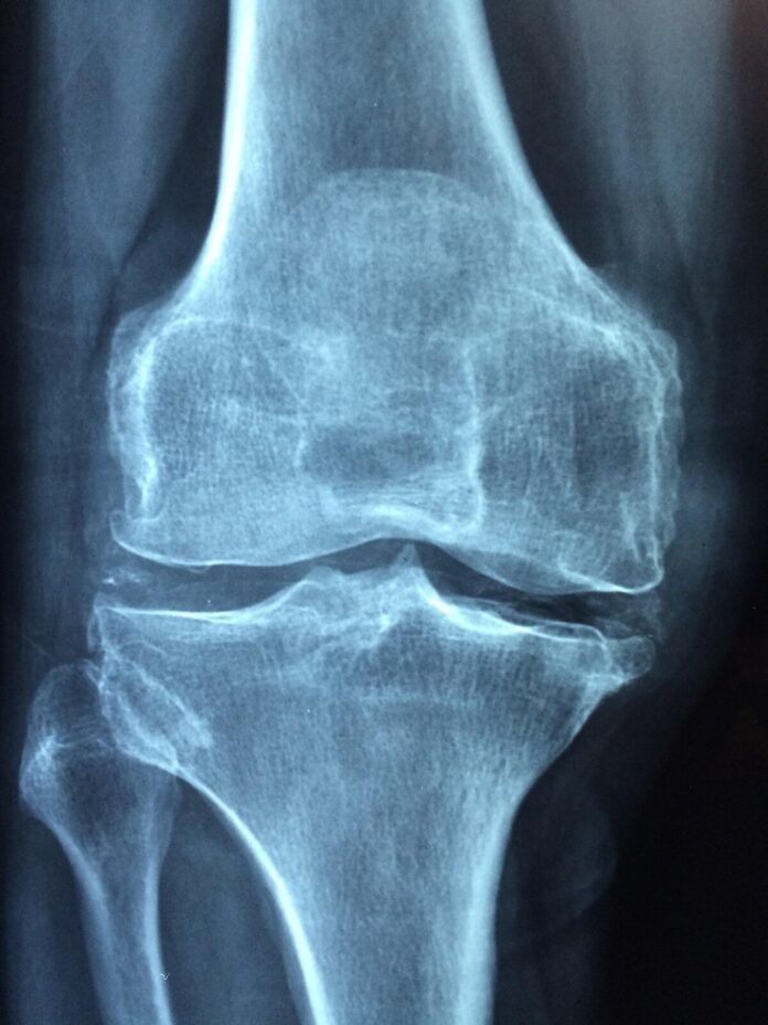 Osteoporosi